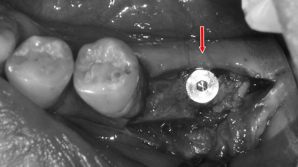 歯がグラグラして抜歯後の治療 ― 6番欠損部へのインプラント埋入