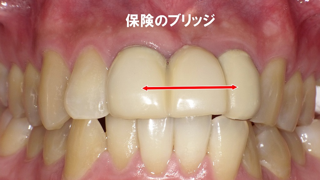 右上１番・左上１番・２番のブリッジ：保険適用