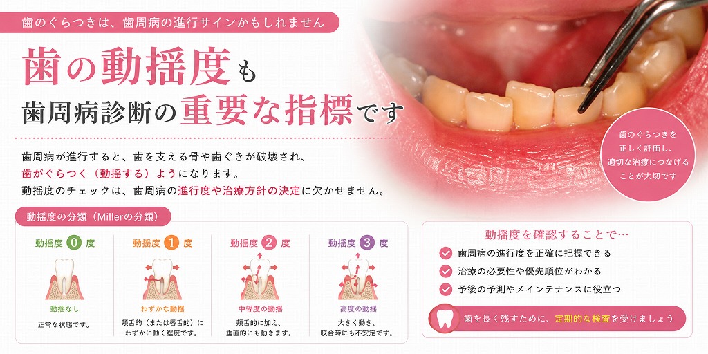 歯の動揺度も歯周病診断の重要な指標