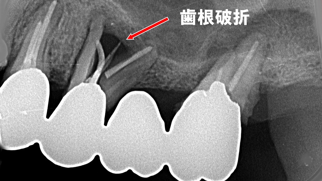 赤矢印の先に見えるのが、縦に割れた5番の歯根。歯根破折は治らないため抜歯が必要です。