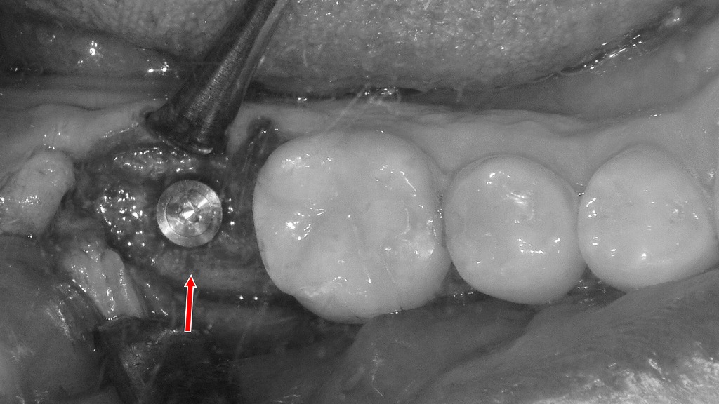 抜歯後にインプラントを選択した症例(下顎7番)
