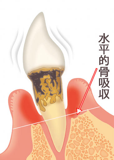 適応されない症例:水平性骨吸収