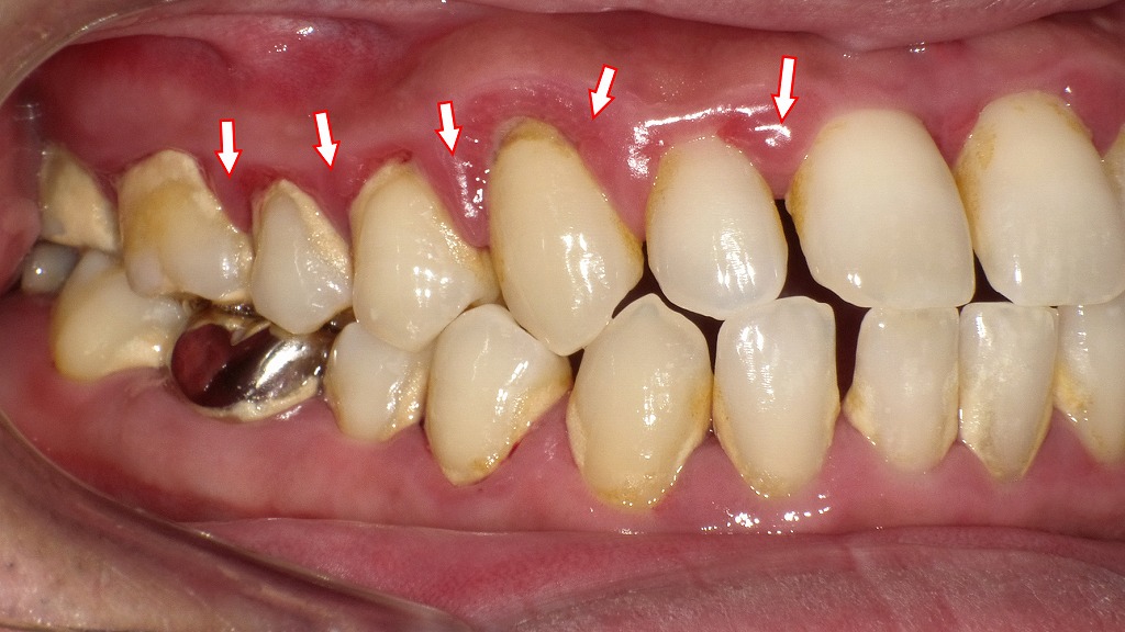 歯周病の症例