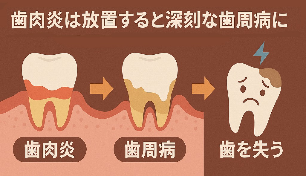 歯肉炎を放置すると、進行し「歯周病」へ