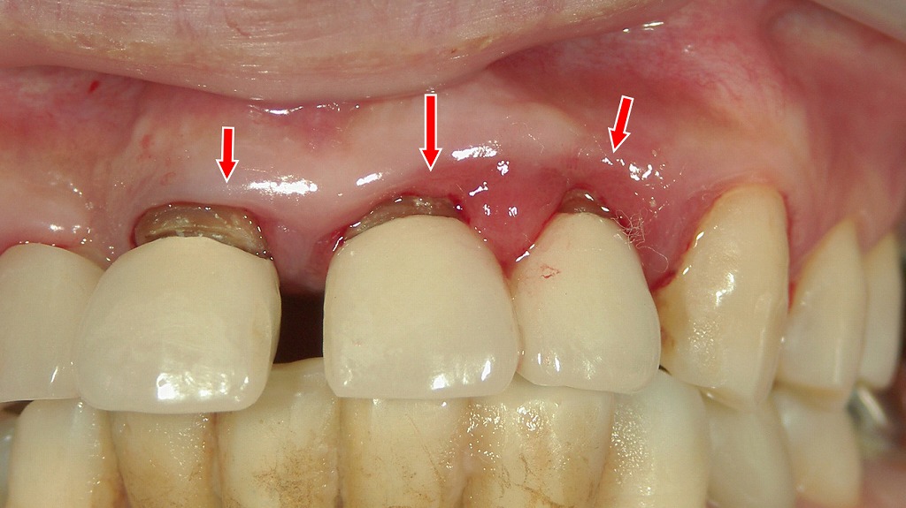 歯周外科治療（フラップ手術）で歯周病を改善するアプローチ
