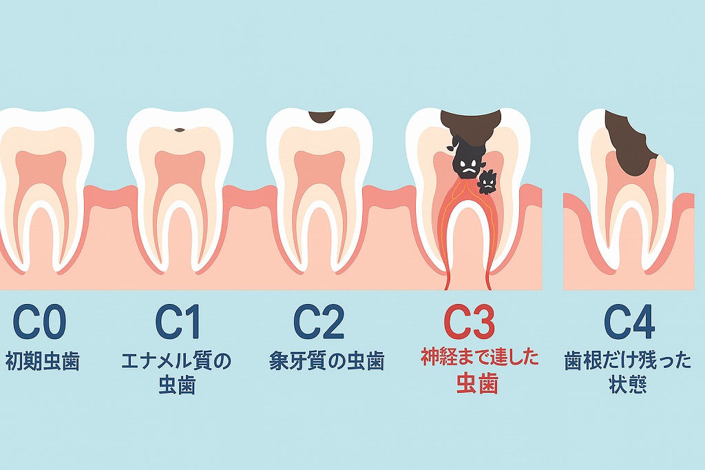 虫歯の進行度「C0〜C4」