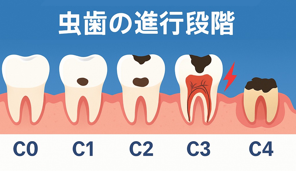 虫歯の進行段階
