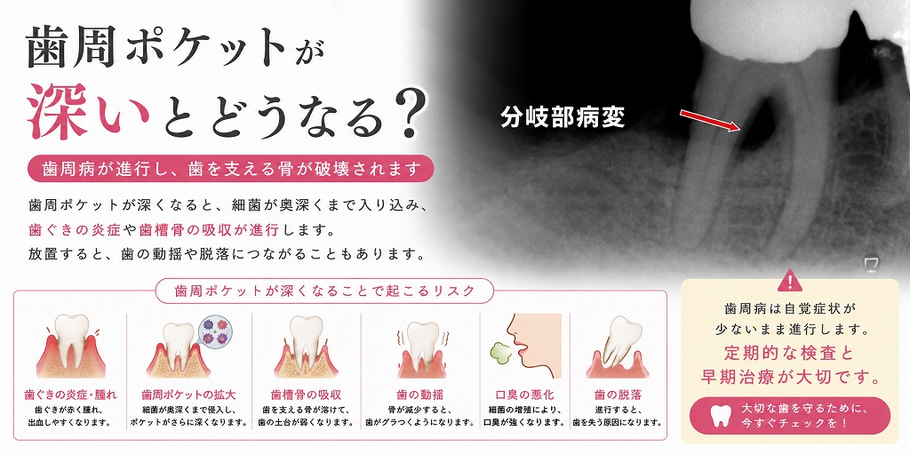 歯周ポケットが深いとどうなる？