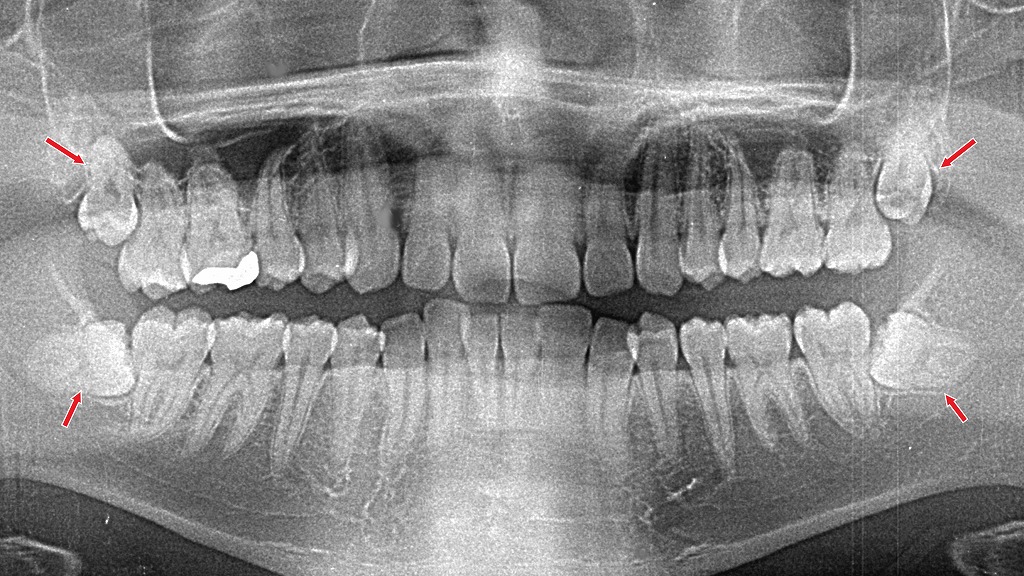 斜めや横向きに生えた親知らずは抜歯が難しく、処置後に出血が続きやすいことがあります。適切な圧迫止血と術後の注意が重要です。