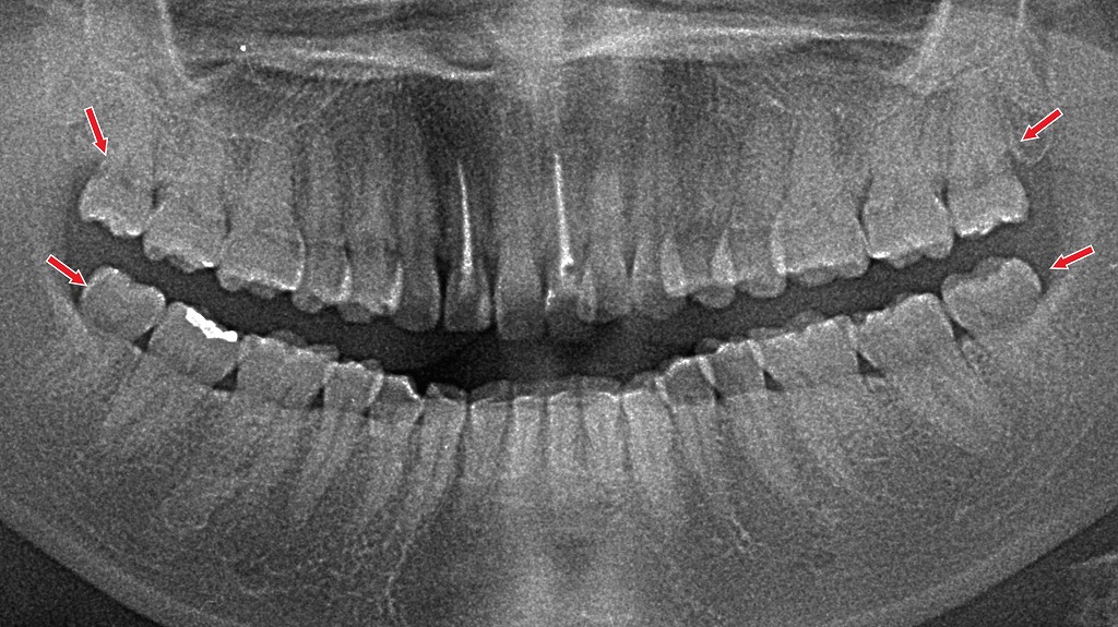 まっすぐ生えて清掃しやすい親知らずは、問題がなければ抜かずに“残す”選択ができます。定期チェックで健康維持が可能です。