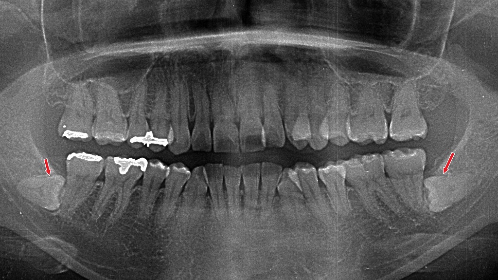 横向きに埋まった親知らずは“難抜歯”。
痛みや腫れが強く出やすいタイプです。