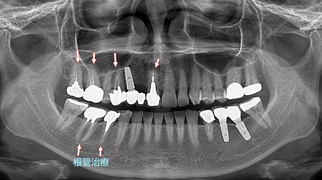 パノラマレントゲン（パントモ）：矢印は根管治療の状態を確認