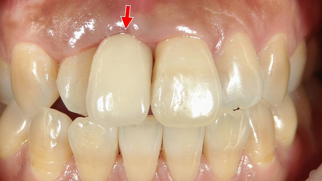クラウン（人工歯）:メタルボンド
