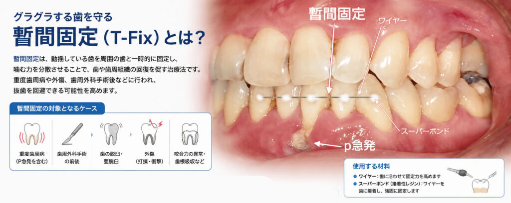 抜歯を回避できることも！暫間固定（T-Fix）の目的と効果