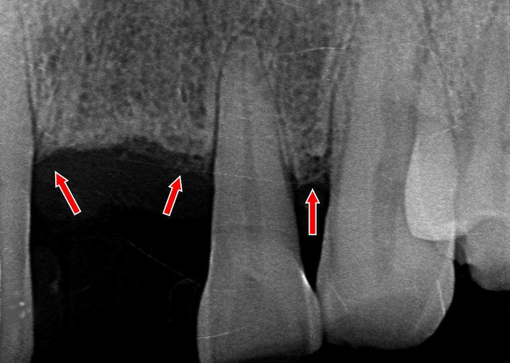 矢印：歯周病による骨の全体的な低下＝水平性骨吸収。