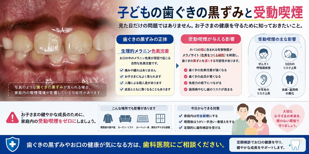 子どもの歯ぐきの黒ずみと受動喫煙