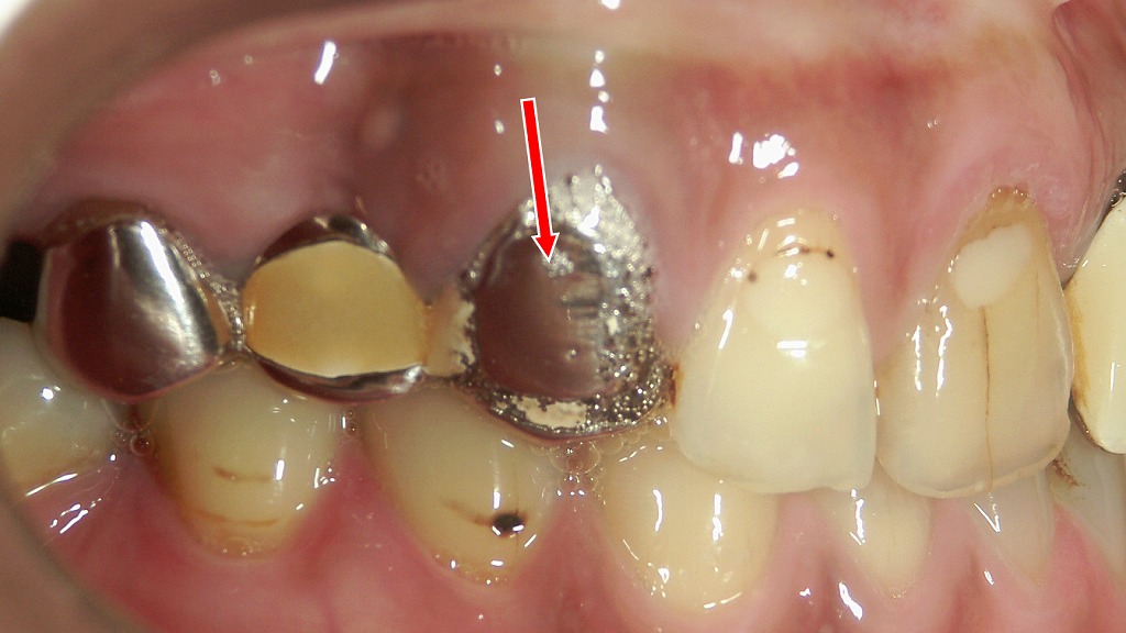 硬質レジン前装冠ブリッジの前装部が脱落した症例