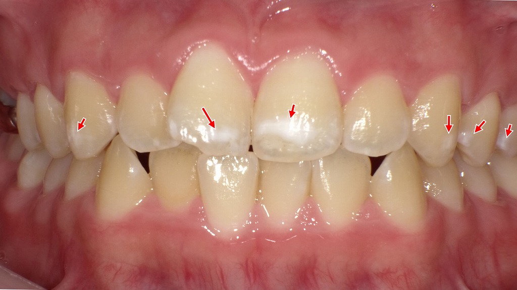 ホワイトスポット・エナメル質形成不全