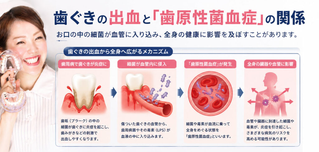 歯ぐきの出血と「歯原性菌血症」の関係
