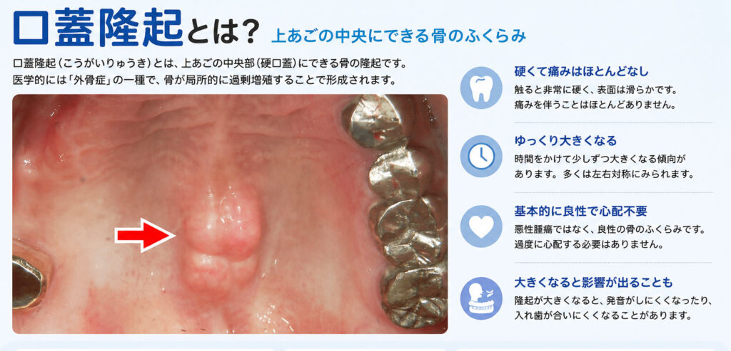 口蓋隆起とは
