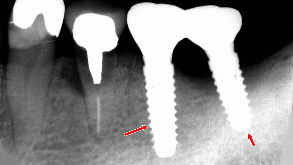抜歯後の骨量を考慮したインプラント治療