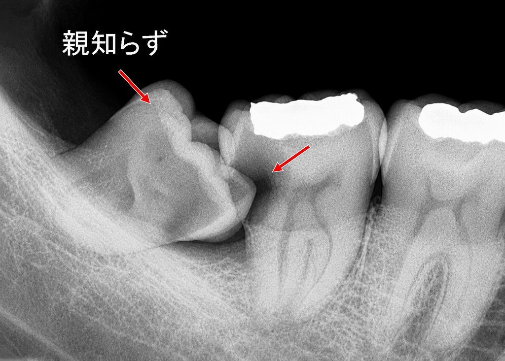 横向きの親知らずは虫歯や炎症のリスクが高い