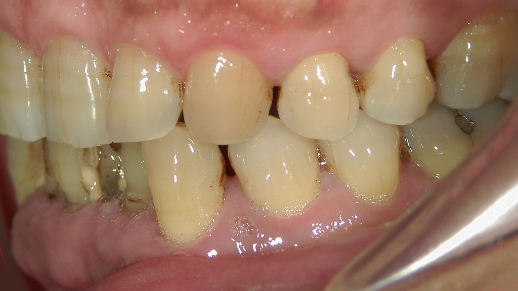 歯ぐきの炎症が強く、歯石とプラークが深い位置まで付着している状態。