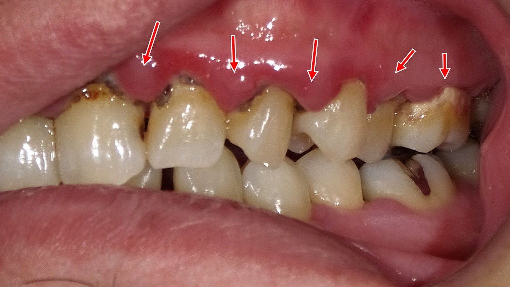 歯周病が原因で起こる「自分では気づきにくい口臭」