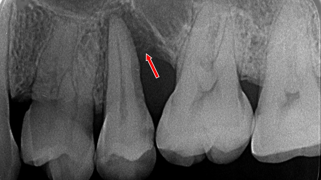 矢印部のような垂直性の骨吸収は重度に見えても、原因除去と適切な環境が整えば「歯周組織再生療法」で骨の再生を狙えることがあります。歯を残せる可能性が広がる治療選択肢です。