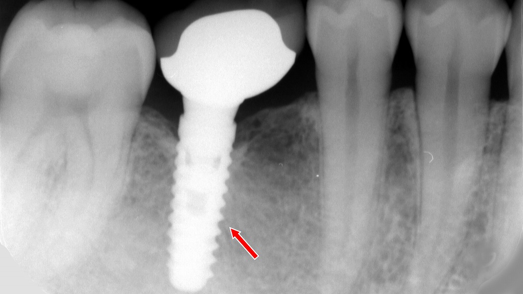 下顎6番部の歯根破折後に行ったインプラント埋入のX線所見