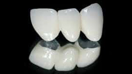 メタルボンドブリッジ