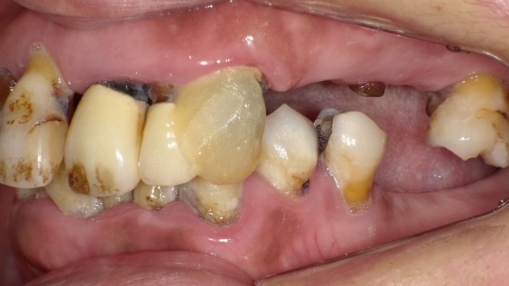 口腔細菌が全身の血管を蝕む――歯周病と動脈硬化の深い関係