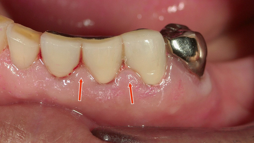 連結冠まわりに起きた歯周炎と出血