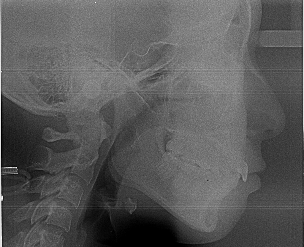 セファロレントゲン撮影