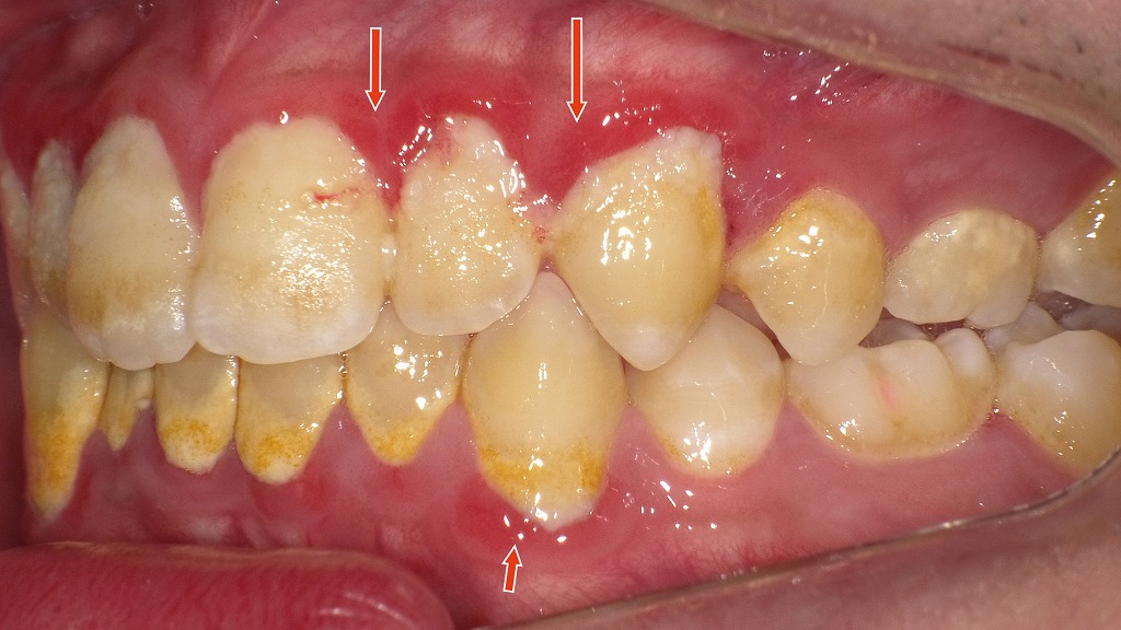 歯肉炎・歯周炎