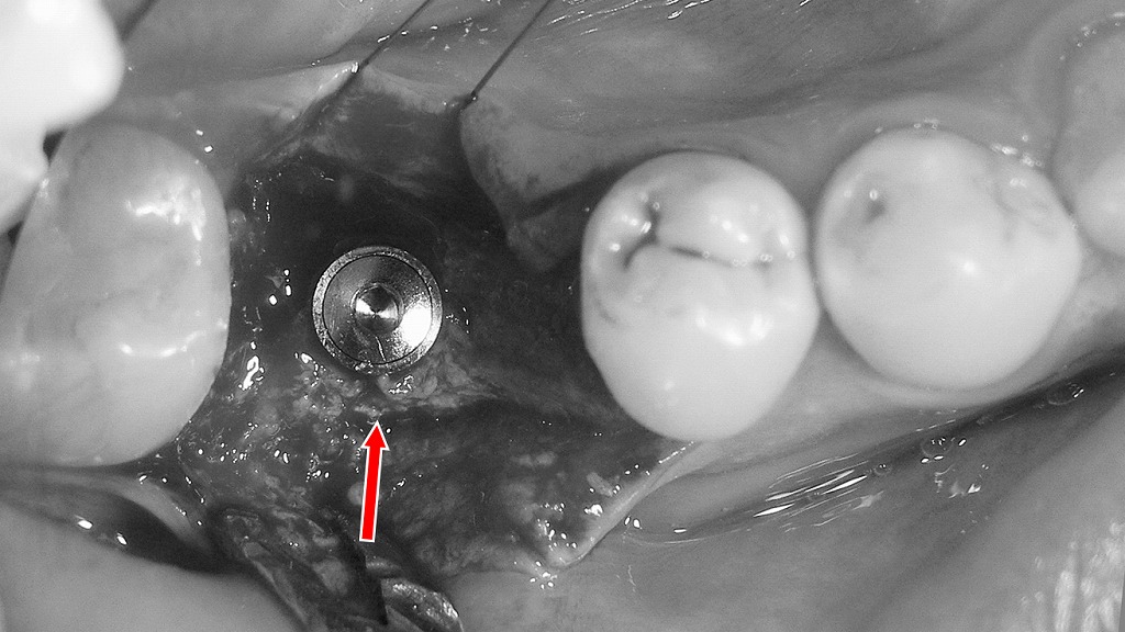 歯根破折への対応:下顎6番にインプラント埋入した症例