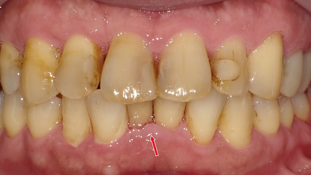 妊娠中に歯周病が悪化しやすい理由｜ホルモン変化と口腔ケアの重要性