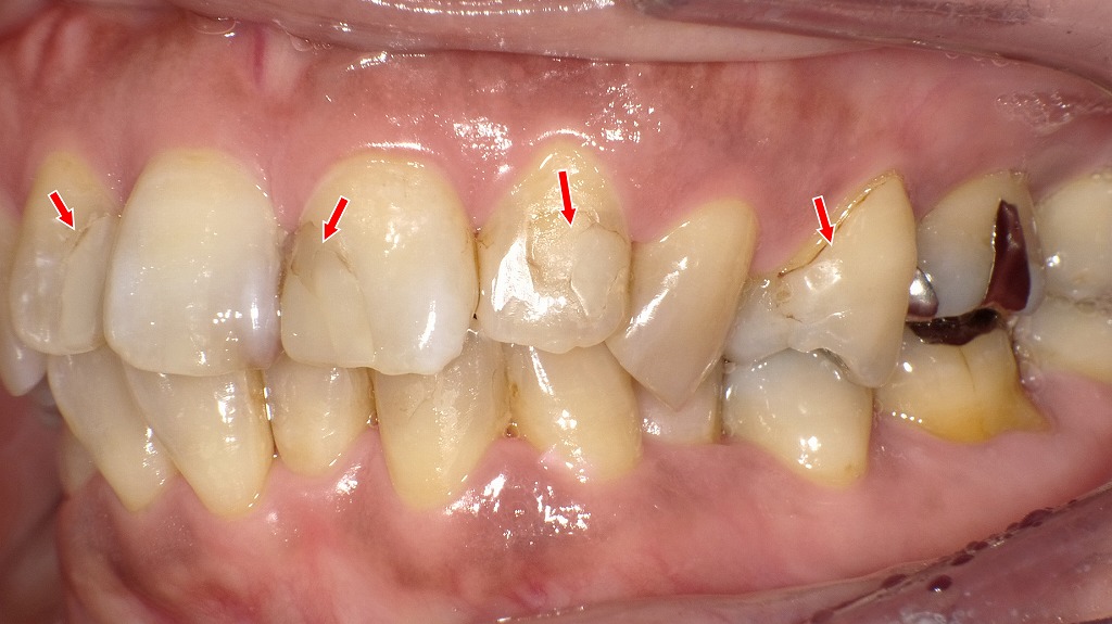 コンポジットレジンの弱点:変色・摩耗が進行した症例