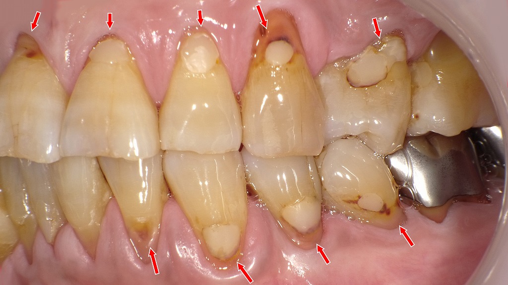 歯ぐきが下がり、露出した根面に虫歯（根面う蝕）が帯状に広がっている状態。複数の歯で進行が確認されます。