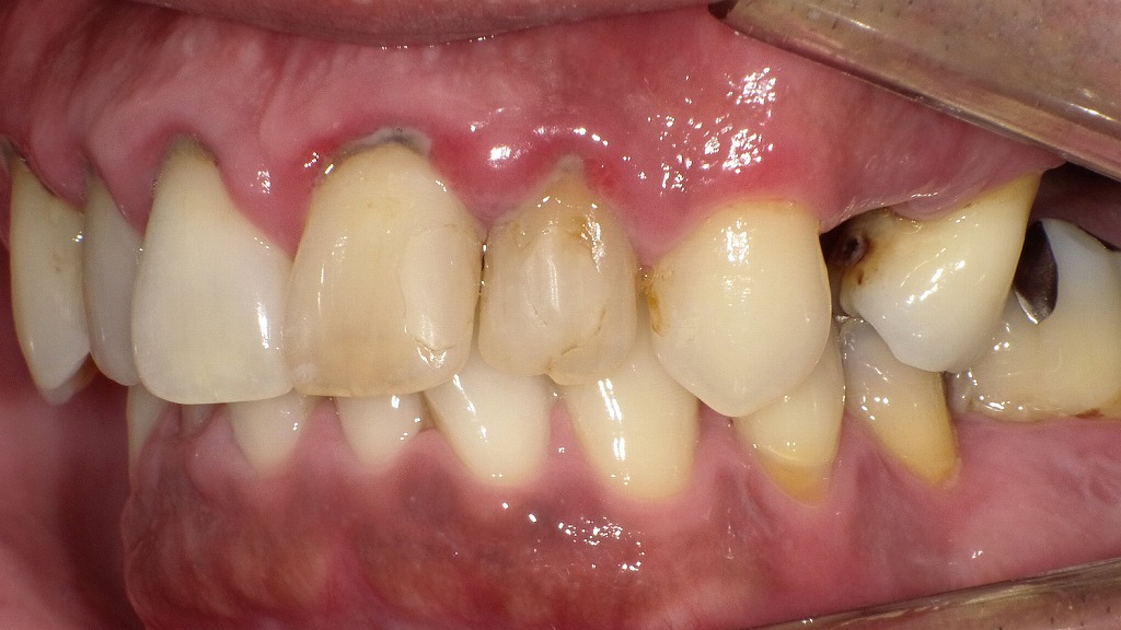重度歯周病:正面