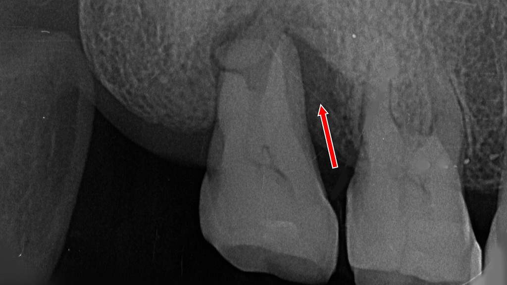 重度歯周病による骨吸収。早産リスクが6.8倍に上昇