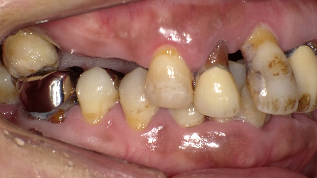 歯周病が進むと歯ぐきから膿が出る――重度感染のサイン