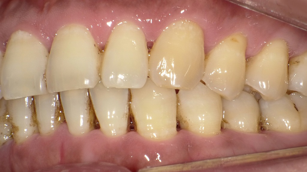 デブライドメントの重要性：歯周病を進行させる歯垢・歯石を徹底除去