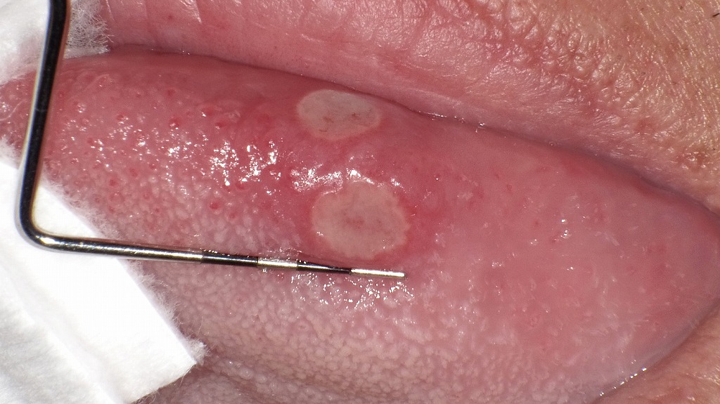 舌の白いできもの：典型的なアフタ性潰瘍