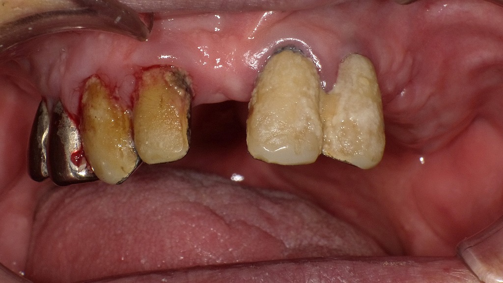 口腔機能低下症が疑われる口腔内所見。残存歯に厚いプラークが付着し、自浄作用の低下や清掃不良が明確にみられる状態です。