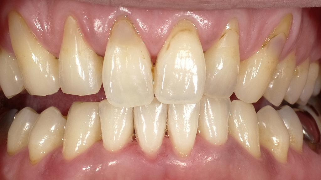 【After（ホワイトニング後）】