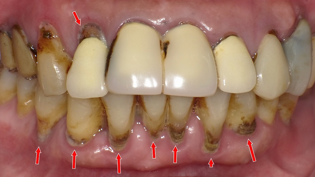 歯肉縁下の黒い歯石