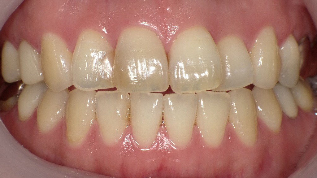 ホワイトニング術前