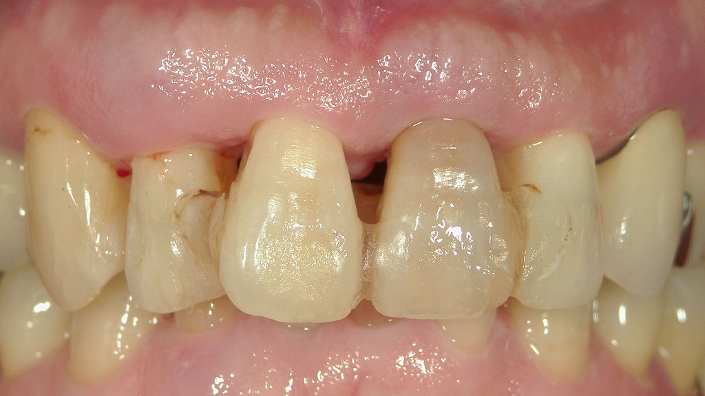 歯周外科手術前:スーパーボンドで暫間固定