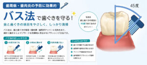 歯周病・歯肉炎の予防に効果的な「バス法」